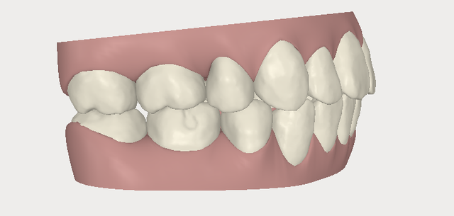 invisalign,[mC_