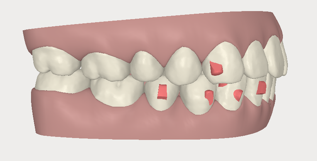 invisalign,[mC_