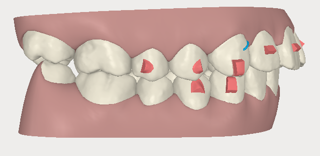 invisalign,[mC_