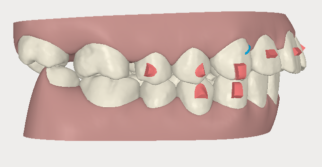 invisalign,[mC_