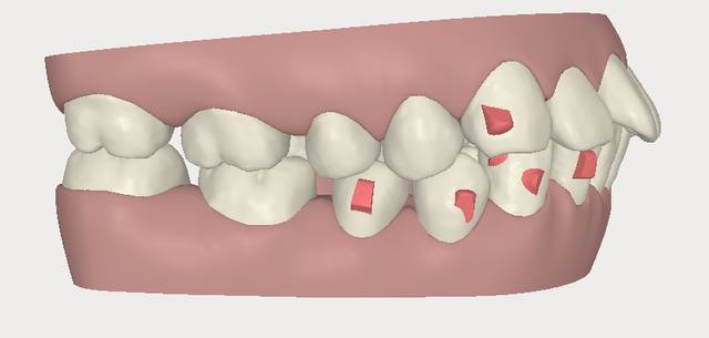 invisalign,[mC_