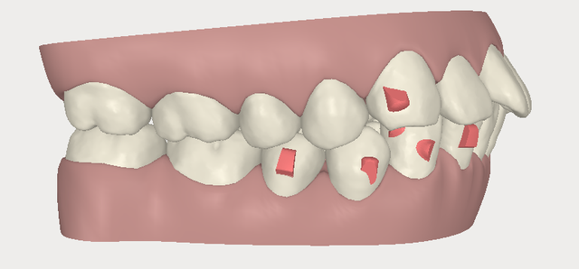 invisalign,[mC_