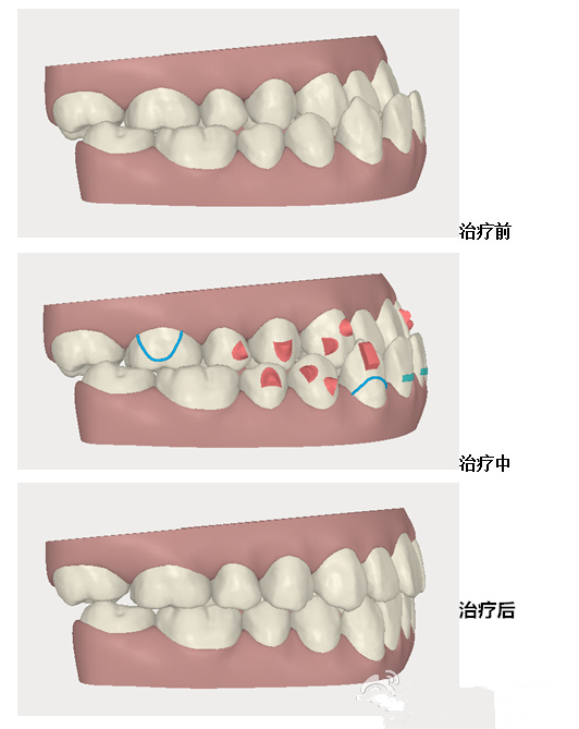 Invisalign[mίذ족ă(yu)ݺO(sh)Ӌ