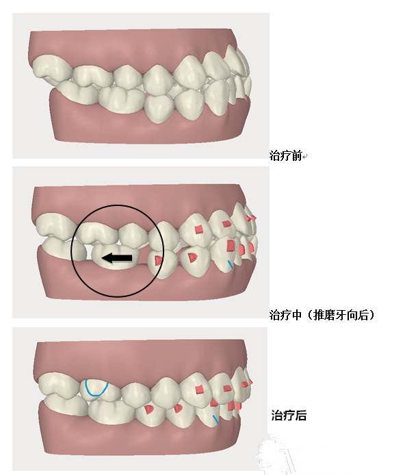 Invisalign[mίذ족ă(yu)ݺO(sh)Ӌ