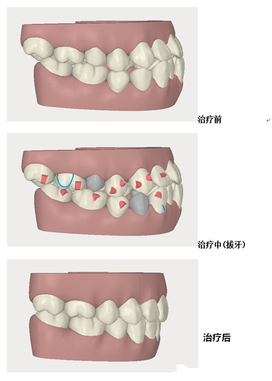 Invisalign[mίذ족ă(yu)ݺO(sh)Ӌ